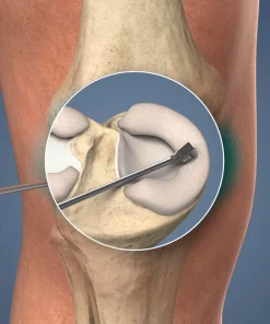 Arthroscopy