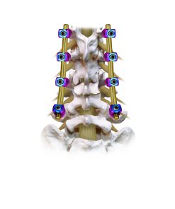 Spinal Implants