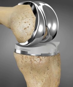Joints Prosthesis